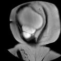 Benign seromucinous cystadenoma of the ovary (Radiopaedia 71065-81300 F 4).jpg