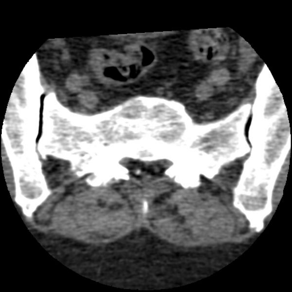 File:Bertolotti syndrome (Radiopaedia 24864-25128 Axial non-contrast 25).jpg