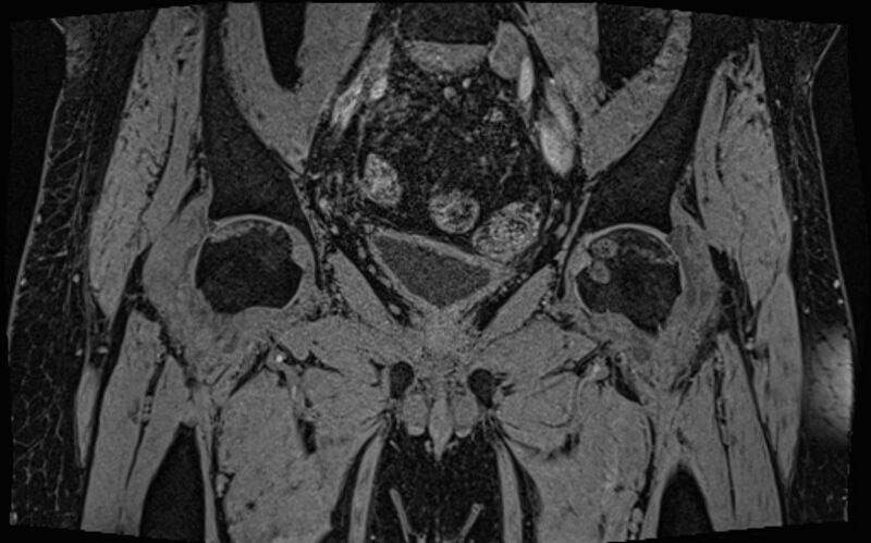 File:Bilateral avascular necrosis of femoral head (Radiopaedia 77116-89078 Coronal T2 we 48).jpg