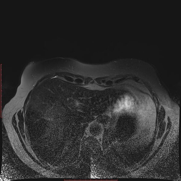 File:Bilateral breast implant rupture (Radiopaedia 24761-25027 T2 fat sat 36).jpg
