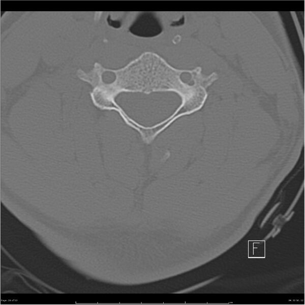 File:Bilateral cervical ribs (Radiopaedia 25868-26017 Axial bone window 26).jpg