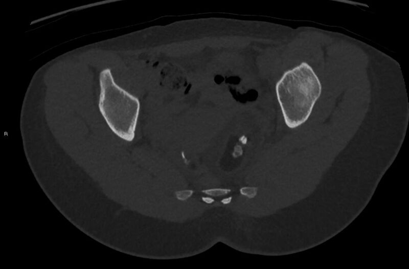 File:Bilateral mature cystic ovarian teratoma (Radiopaedia 88821-105592 Axial bone window 25).jpg