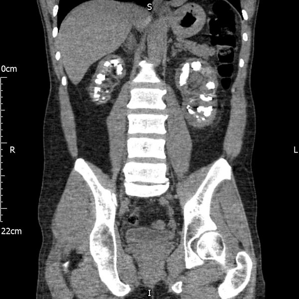 File:Bilateral medullary nephrocalcinosis with ureteric calculi (Radiopaedia 71269-81569 Coronal non-contrast 44).jpg