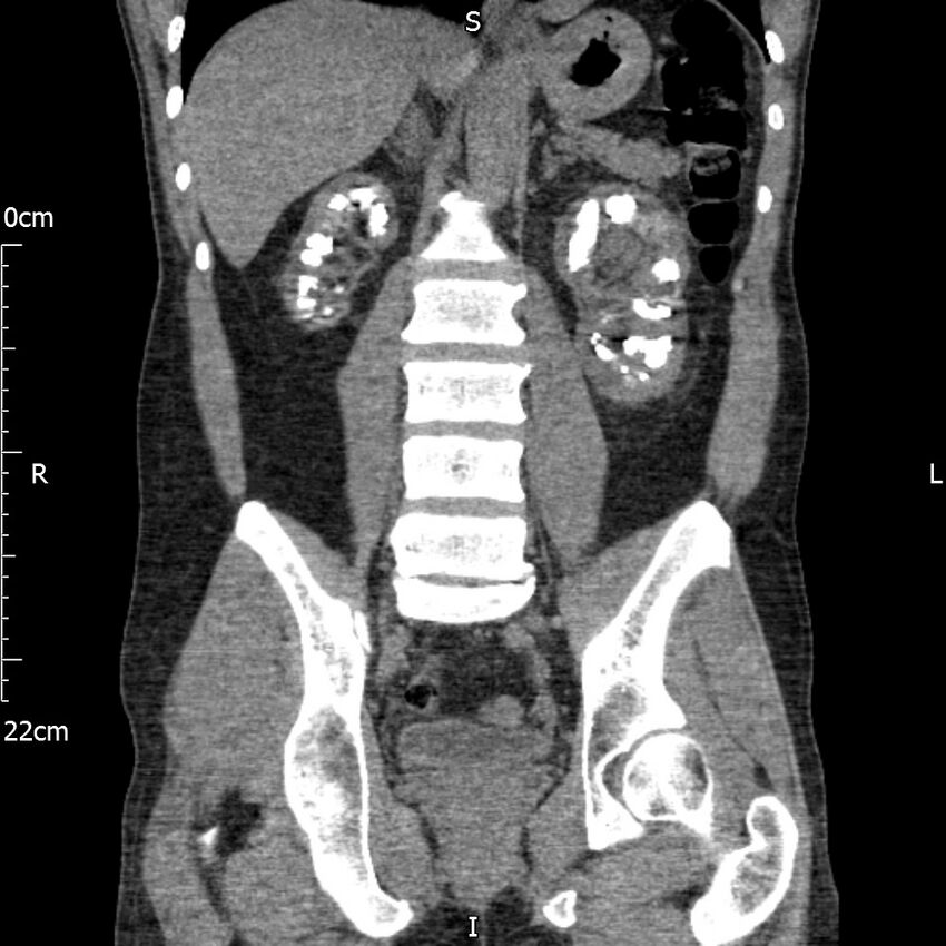 Bilateral medullary nephrocalcinosis with ureteric calculi (Radiopaedia 71269-81569 Coronal non-contrast 44).jpg