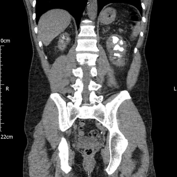 File:Bilateral medullary nephrocalcinosis with ureteric calculi (Radiopaedia 71269-81569 Coronal non-contrast 50).jpg