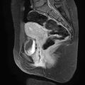 Bilateral ovarian endometriomas (Radiopaedia 87085-103347 F 12).jpg