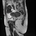 Bilateral ovarian fibroma (Radiopaedia 44568-48293 Sagittal T2 24).jpg