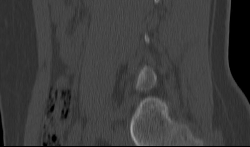 Bilateral pars defect (Radiopaedia 26691-26846 Sagittal bone window 15).jpg