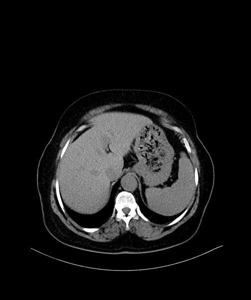 File:Bilateral sporadic synchronous clear cell renal cell carcinoma (Radiopaedia 85035-100572 Axial non-contrast 10).jpg