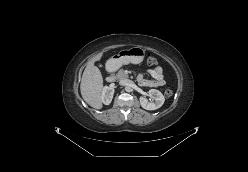 File:Bilateral urolithiasis with incidentally detected splenic artery aneurysm and left inferior vena cava (Radiopaedia 44467-48127 B 33).jpg
