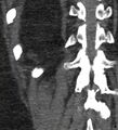 Bile leak from accessory duct(s) of Luschka post cholecystectomy (Radiopaedia 40736-43389 B 66).jpg