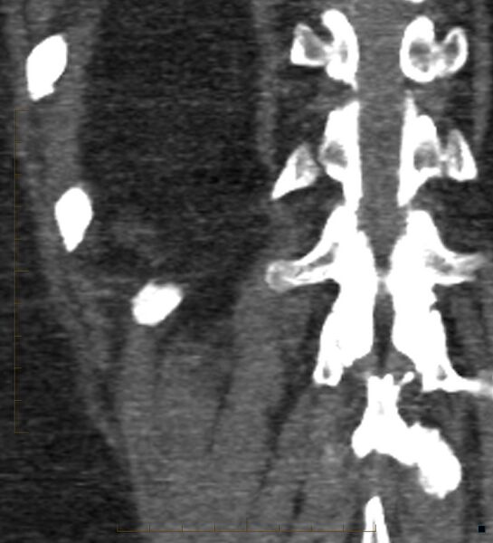 File:Bile leak from accessory duct(s) of Luschka post cholecystectomy (Radiopaedia 40736-43389 B 66).jpg