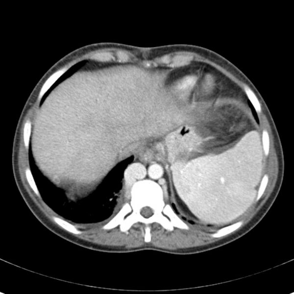 File:Biliary necrosis - liver transplant (Radiopaedia 21876-21846 B 9).jpg