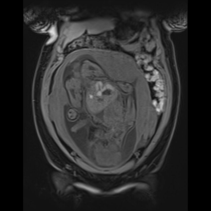 Bilobed placenta accreta (Radiopaedia 69648-79591 Coronal T1 vibe 51).jpg