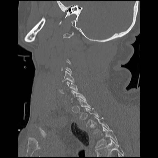 File:Blunt cerebrovascular injury (Radiopaedia 53682-59743 Sagittal bone window 17).png