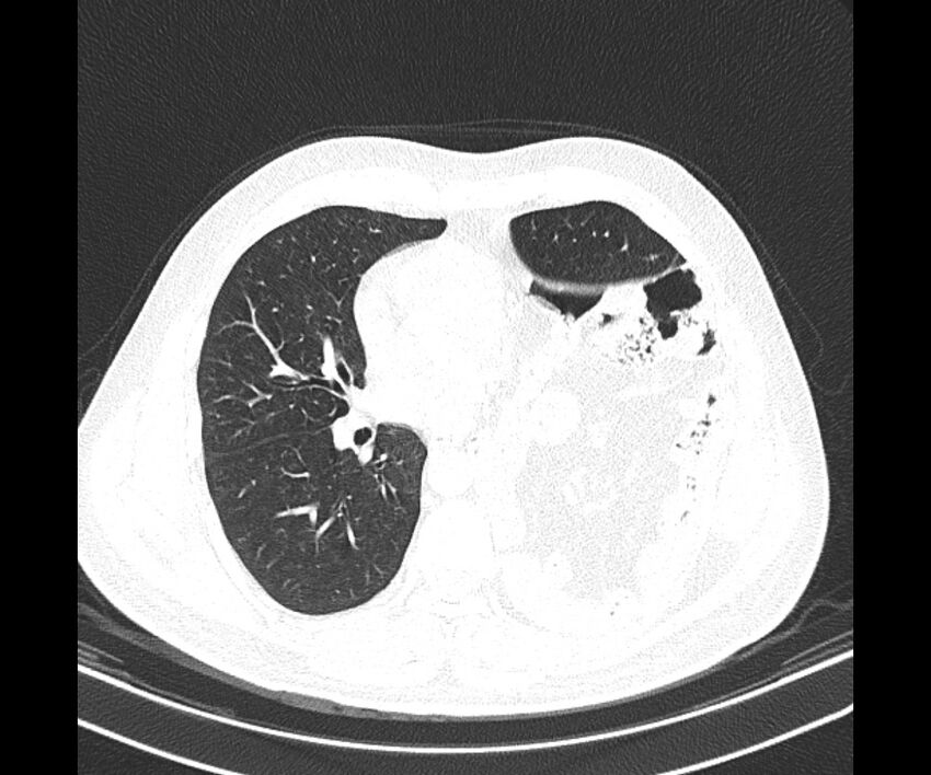 Bochdalek hernia - adult presentation (Radiopaedia 74897-85925 Axial lung window 25).jpg