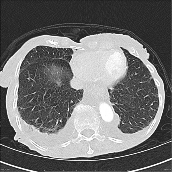 File:Boerhaave syndrome (Radiopaedia 26240-26362 Axial lung window 39).jpg