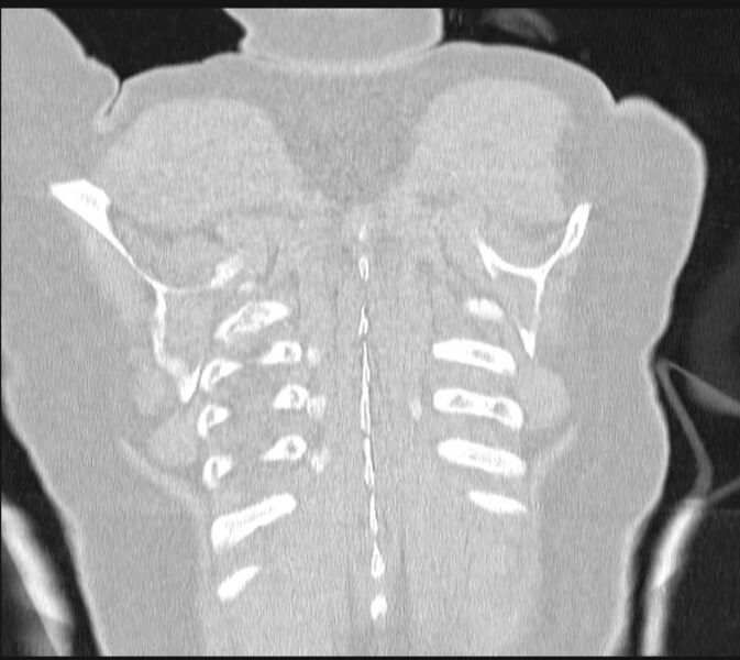 File:Boerhaave syndrome (Radiopaedia 45644-49799 Coronal lung window 65).jpg
