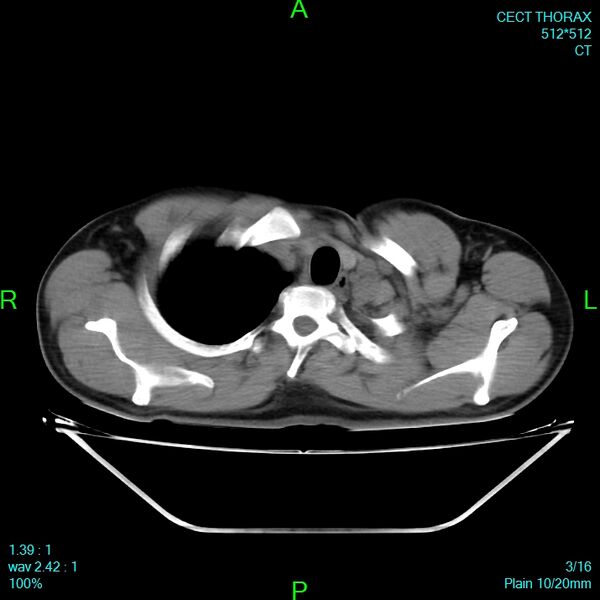 File:Bone metastases from lung carcinoma (Radiopaedia 54703-60937 Axial non-contrast 3).jpg