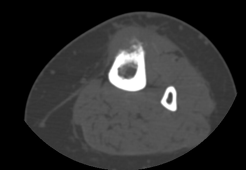 Bone metastasis - tibia (Radiopaedia 57665-64609 Axial bone window 91).jpg