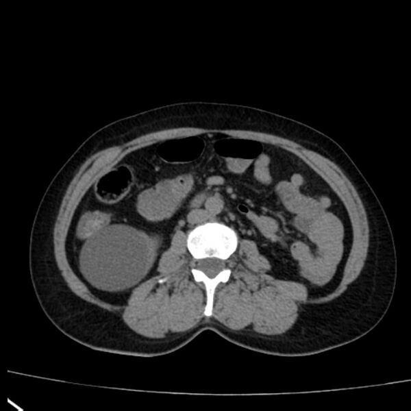 File:Bosniak renal cyst - type I (Radiopaedia 27479-27675 Axial non-contrast 47).jpg
