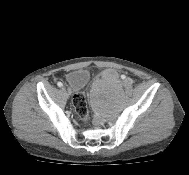 File:Bowel lymphoma complicated by bleeding after therapy (Radiopaedia 55601-62107 A 68).jpg