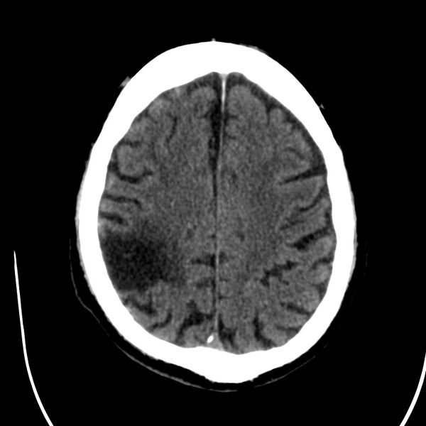 File:Brain Pantopaque remnants (Radiopaedia 78403-91048 Axial non-contrast 66).jpg