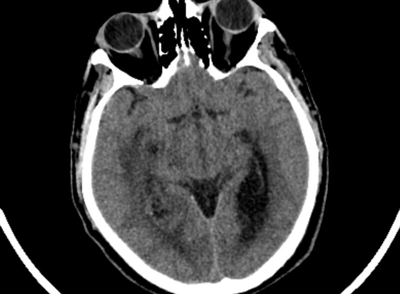 File:Brain abscess complicated by intraventricular rupture and ventriculitis (Radiopaedia 82434-96575 Axial non-contrast 26).jpg