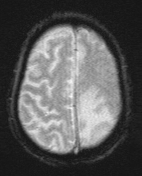 File:Brain abscess with dual rim sign (Radiopaedia 87566-103938 Axial SWI 18).jpg