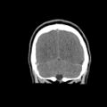 Brain death (Radiopaedia 78597-91360 Coronal non-contrast 62).jpg