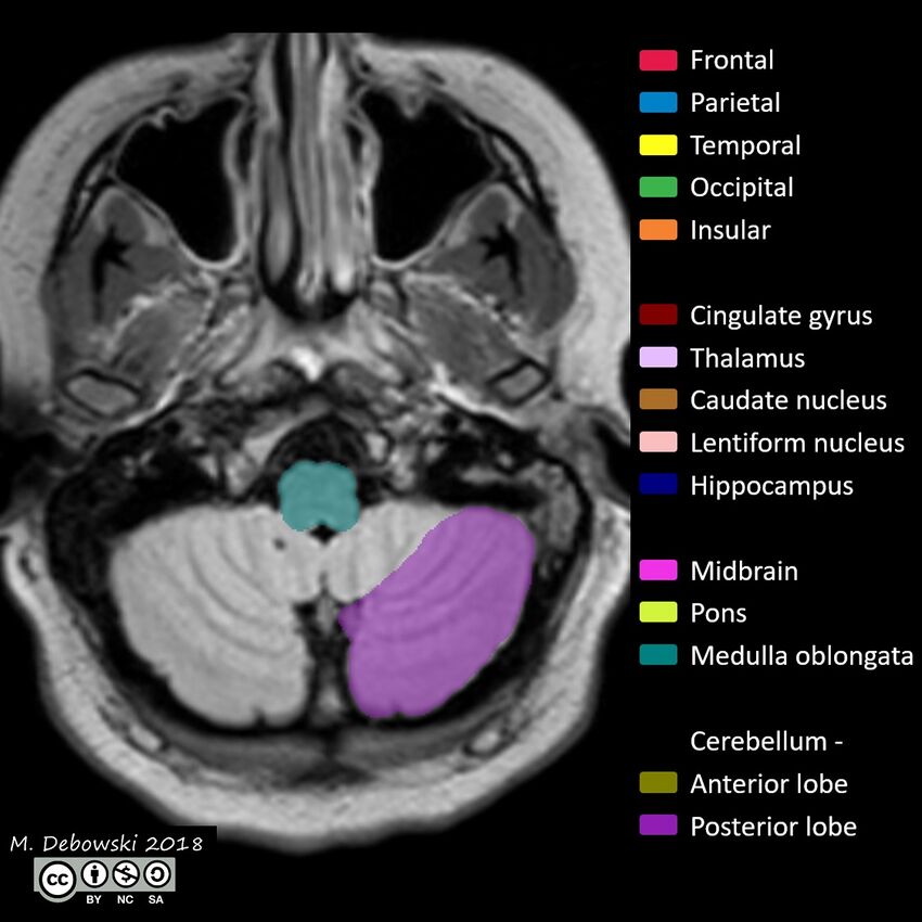Brain lobes - annotated MRI (Radiopaedia 61691-69700 Axial 69).JPG
