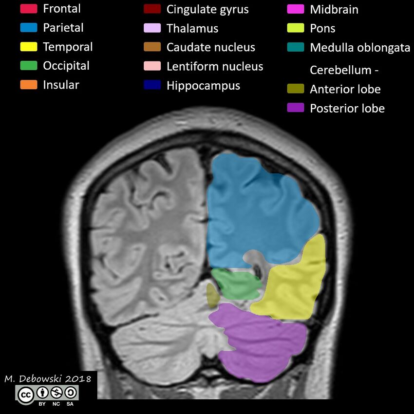 Brain lobes - annotated MRI (Radiopaedia 61691-69700 Coronal 56).JPG