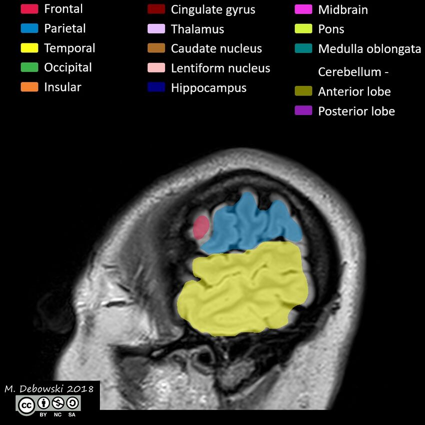 Brain lobes - annotated MRI (Radiopaedia 61691-69700 Sagittal 75).JPG