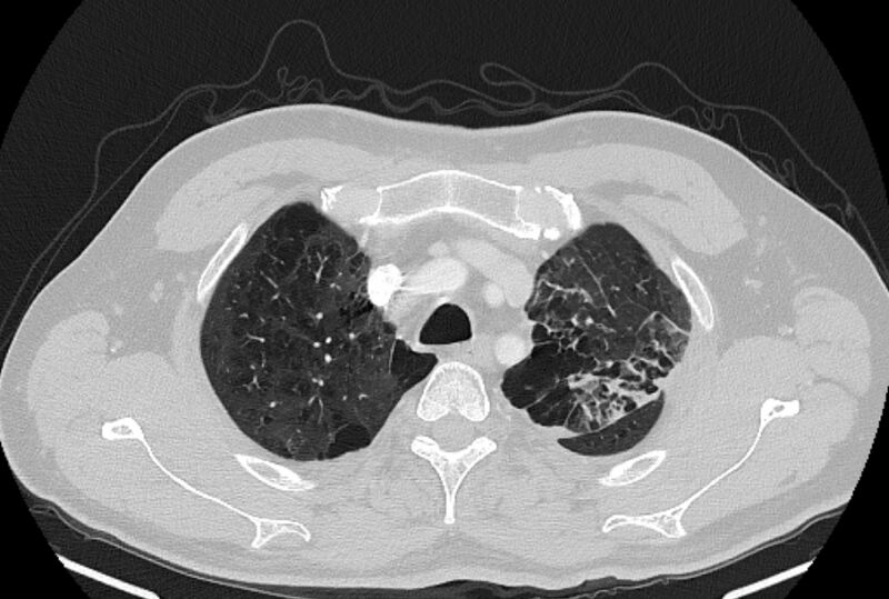 File:Brain metastases - lung cancer primary (Radiopaedia 75060-86116 Axial lung window 9).jpg