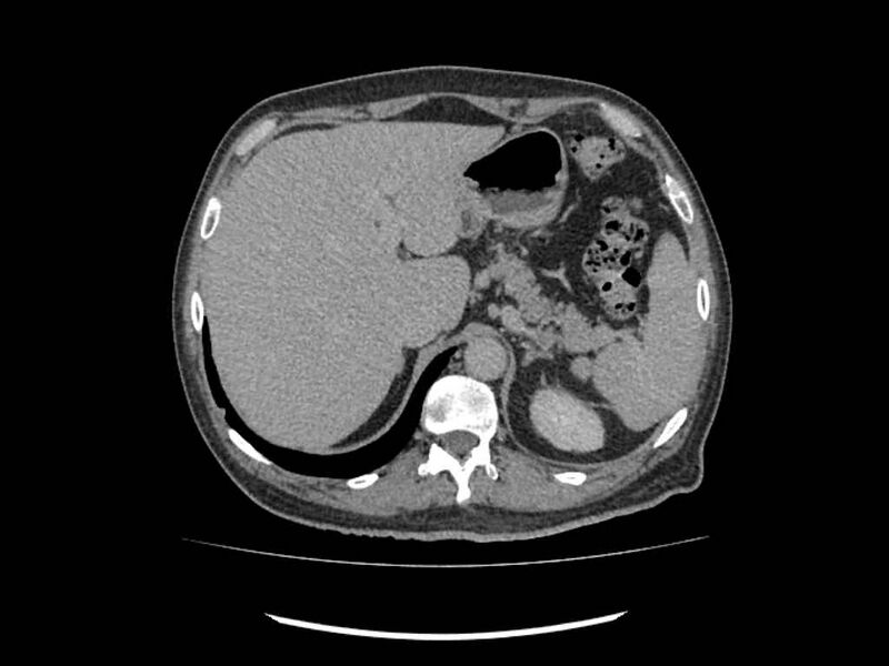 File:Brain metastases from renal cell carcinoma (Radiopaedia 42222-45328 Axial C+ delayed 7).jpg
