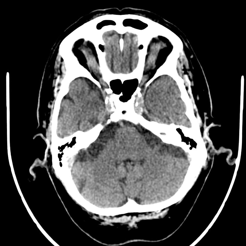 Brain metastasis (Radiopaedia 42617-45760 Axial non-contrast 9).jpg