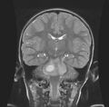 Brainstem glioma (Radiopaedia 11250-11614 B 1).jpg