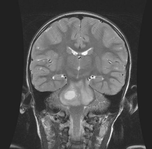 File:Brainstem glioma (Radiopaedia 11250-11614 B 1).jpg