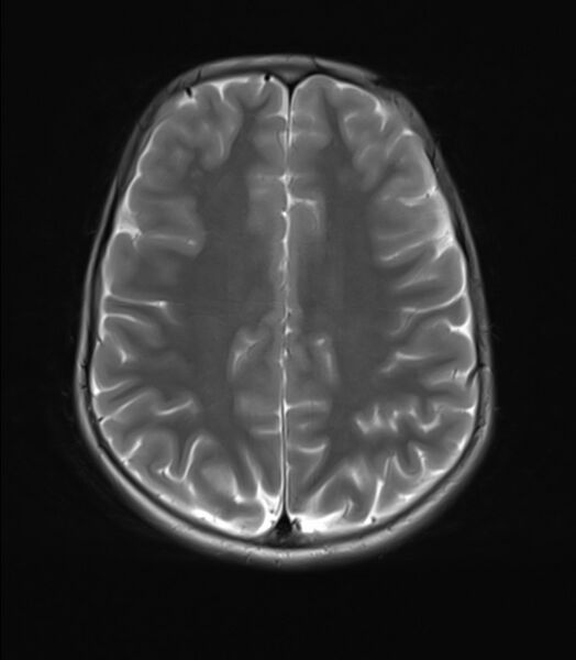 File:Brainstem glioma (Radiopaedia 70548-80674 Axial T2 18).jpg