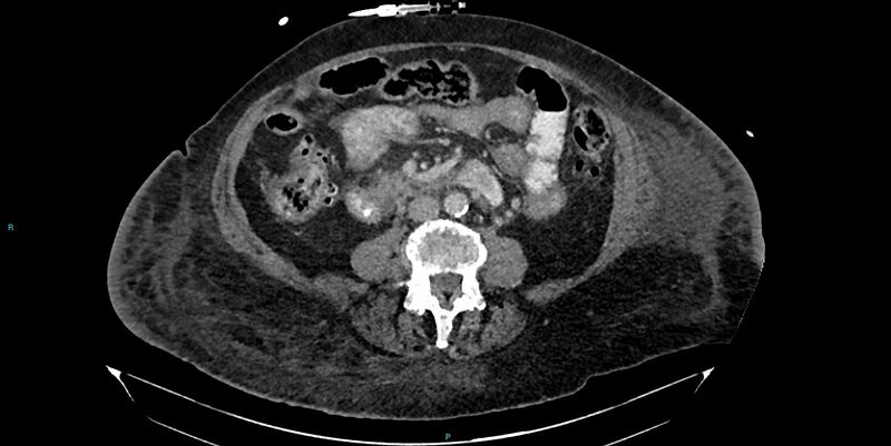 File:Breast cancer pelvic bony metastases (Radiopaedia 84470-99824 Axial bone window 5).jpg