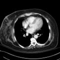 Breast carcinoma with pathological hip fracture (Radiopaedia 60314-67974 A 33).jpg