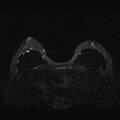Breast implants - MRI (Radiopaedia 26864-27035 T2 SPAIR 27).jpg
