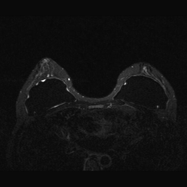 File:Breast implants - MRI (Radiopaedia 26864-27035 T2 SPAIR 27).jpg