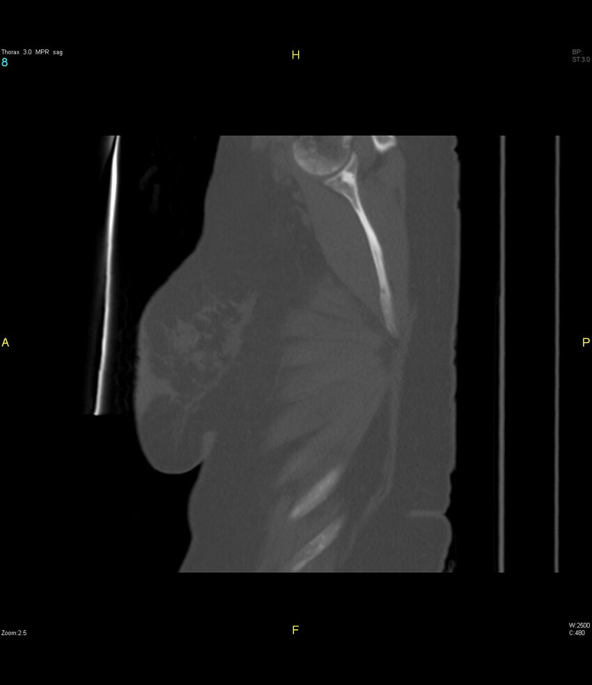 Breast primary with lung and bone metastases (Radiopaedia 40620-43228 Sagittal bone window 8).jpg