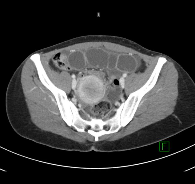File:Broad ligament hernia (Radiopaedia 63260-71832 A 59).jpg