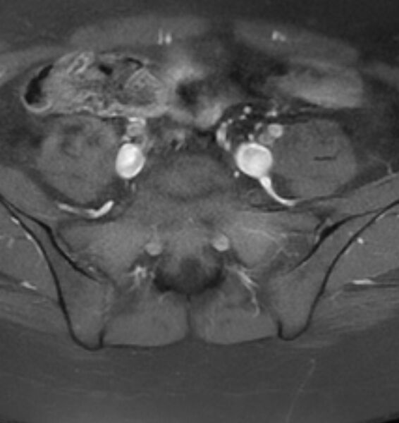 File:Broad ligament leiomyoma (Radiopaedia 81634-95516 Axial T1 C+ fat sat 1).jpg