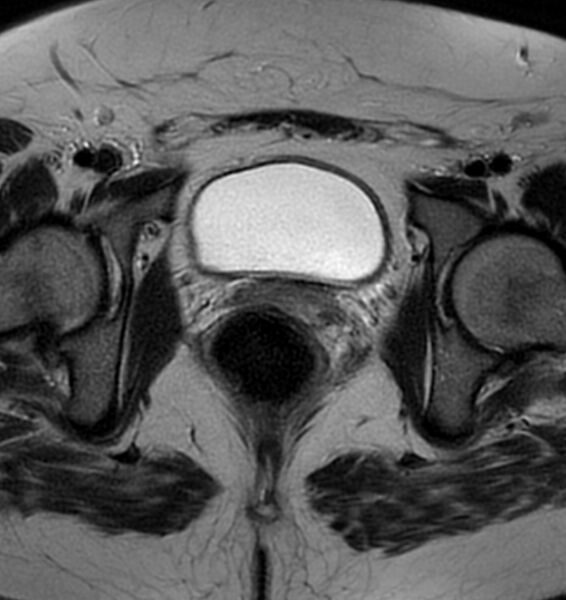 File:Broad ligament leiomyoma (Radiopaedia 81634-95516 Axial T2 21).jpg