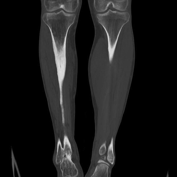 File:Brodie abscess - tibia (Radiopaedia 66028-75204 Coronal bone window 38).jpg