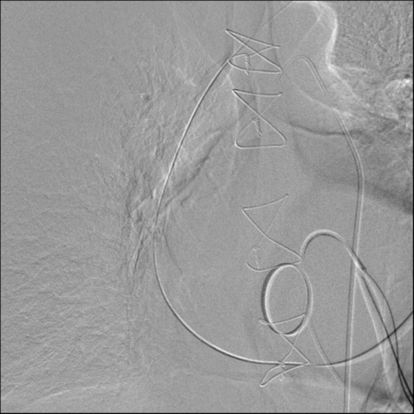 File:Bronchial artery aneurysm (Radiopaedia 33694).png