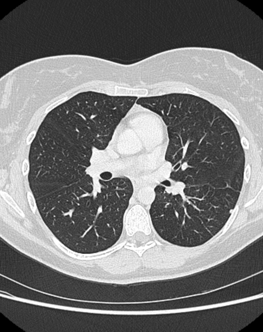 Bronchial atresia (Radiopaedia 50007-55297 Axial lung window 50).jpg